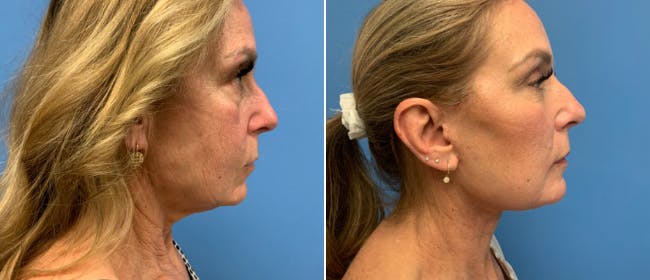 Facelift Before & After Gallery - Patient 38566629 - Image 1