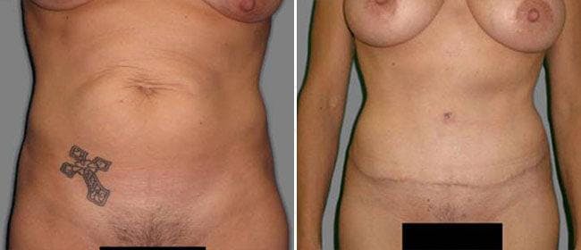 Abdominoplasty (Tummy Tuck) Before & After Gallery - Patient 38566631 - Image 1
