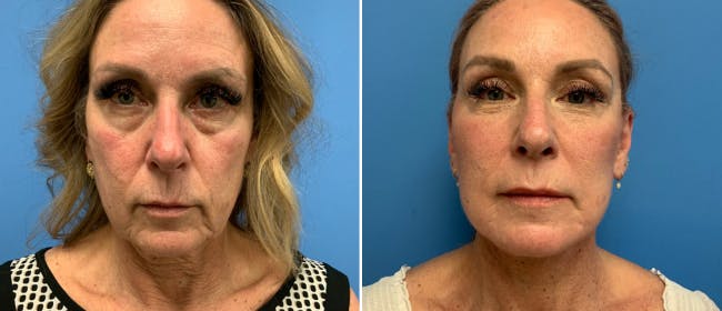 Facelift Before & After Gallery - Patient 38566629 - Image 2
