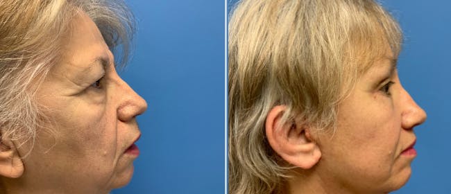 Eyelid Surgery Before & After Gallery - Patient 38566627 - Image 2