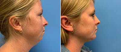 Facial Liposuction Before & After Gallery - Patient 38566636 - Image 1