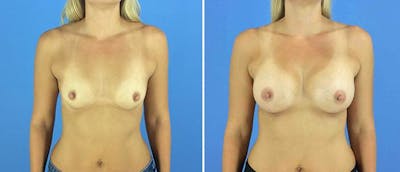 Breast Augmentation Before & After Gallery - Patient 38566633 - Image 1