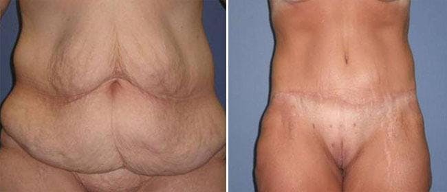Abdominoplasty (Tummy Tuck) Before & After Gallery - Patient 38566637 - Image 1