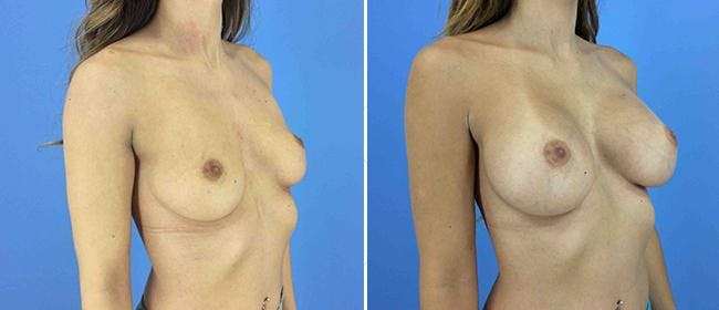 Breast Augmentation Before & After Gallery - Patient 38566639 - Image 1