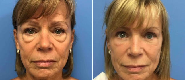 Eyelid Surgery Before & After Gallery - Patient 38566640 - Image 1