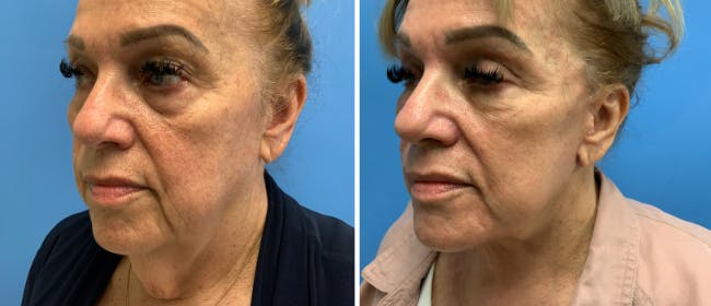 Facelift Before & After Gallery - Patient 38566642 - Image 1