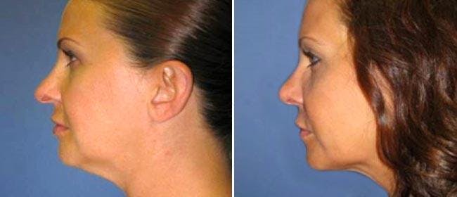 Facial Liposuction Before & After Gallery - Patient 38566641 - Image 1