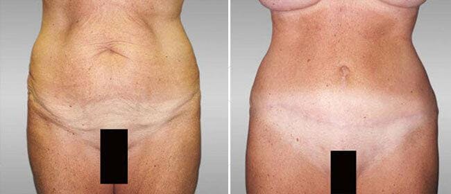 Abdominoplasty (Tummy Tuck) Before & After Gallery - Patient 38566643 - Image 1