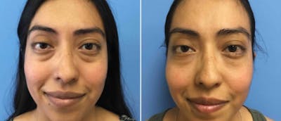 Eyelid Surgery Before & After Gallery - Patient 38566652 - Image 1