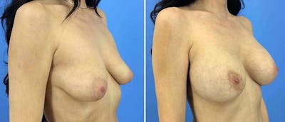 Breast Augmentation Before & After Gallery - Patient 38566645 - Image 1