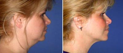 Facial Liposuction Before & After Gallery - Patient 38566646 - Image 1