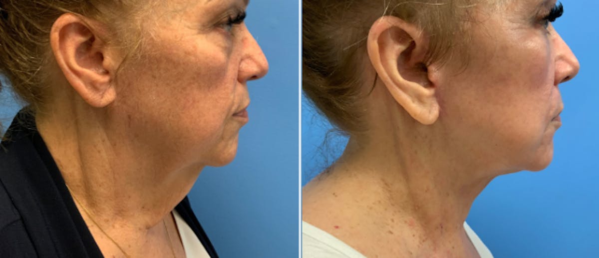 Facelift Before & After Gallery - Patient 38566642 - Image 2