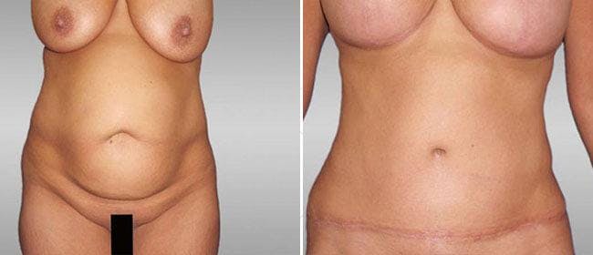 Abdominoplasty (Tummy Tuck) Before & After Gallery - Patient 38566653 - Image 1