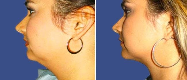 Facial Liposuction Before & After Gallery - Patient 38566650 - Image 1