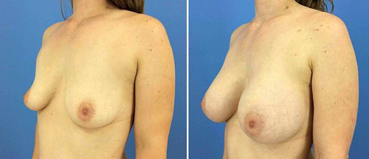 Breast Augmentation Before & After Gallery - Patient 38566651 - Image 1