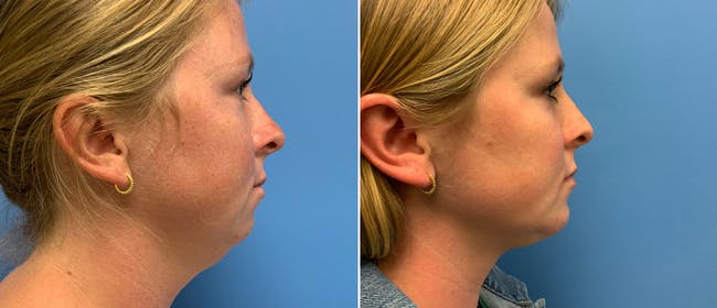 Liposuction Before & After Gallery - Patient 38566656 - Image 1