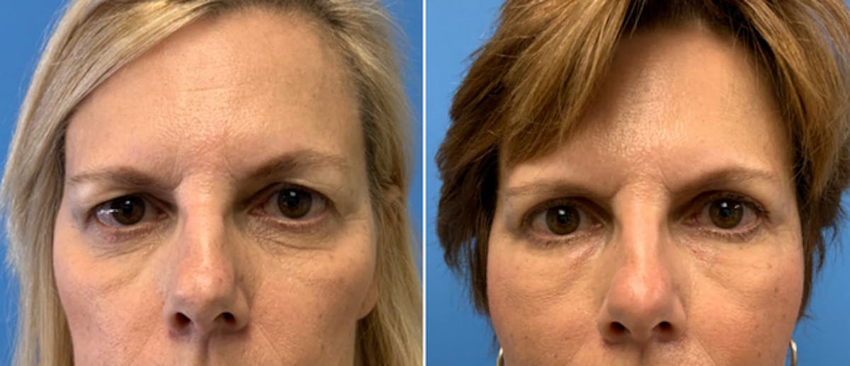 Fat Injections Before & After Gallery - Patient 38566659 - Image 1