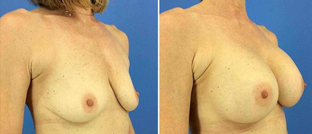 Breast Augmentation Before & After Gallery - Patient 38566657 - Image 1