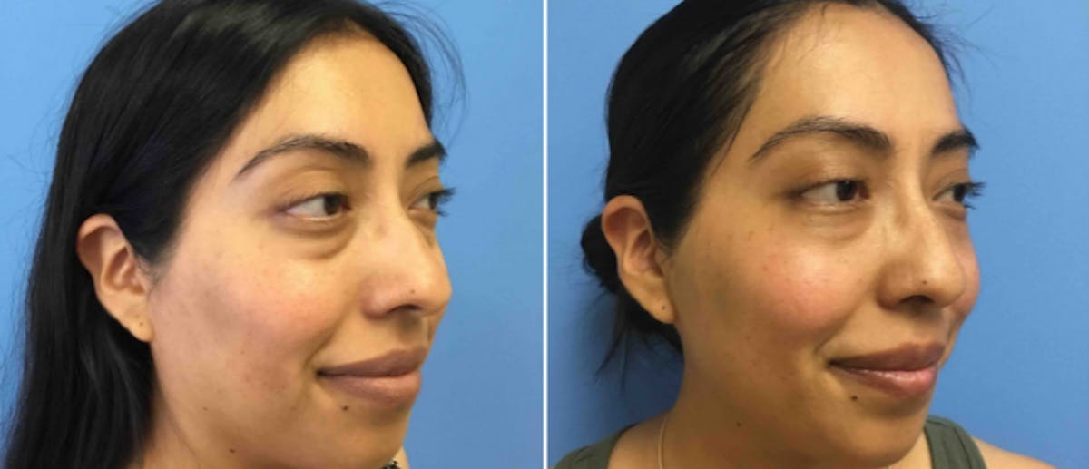 Eyelid Surgery Before & After Gallery - Patient 38566652 - Image 2