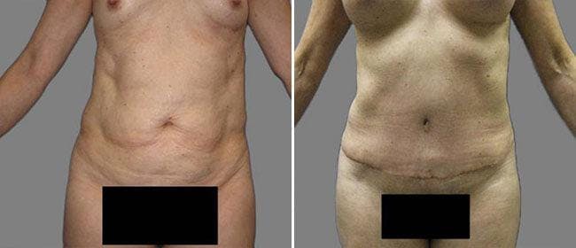 Abdominoplasty (Tummy Tuck) Before & After Gallery - Patient 38566658 - Image 1