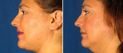 Facial Liposuction Before & After Gallery - Patient 38566661 - Image 1