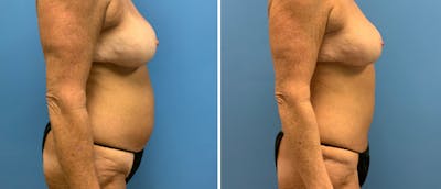 Liposuction / Bodytite Before & After Gallery - Patient 38566663 - Image 1