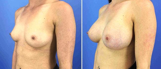 Breast Augmentation Before & After Gallery - Patient 38566662 - Image 1
