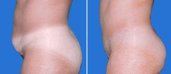 Abdominoplasty (Tummy Tuck) Before & After Gallery - Patient 38566664 - Image 1