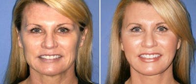 Fat Injections Before & After Gallery - Patient 38566665 - Image 1