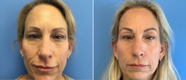 Eyelid Surgery Before & After Gallery - Patient 38566671 - Image 1