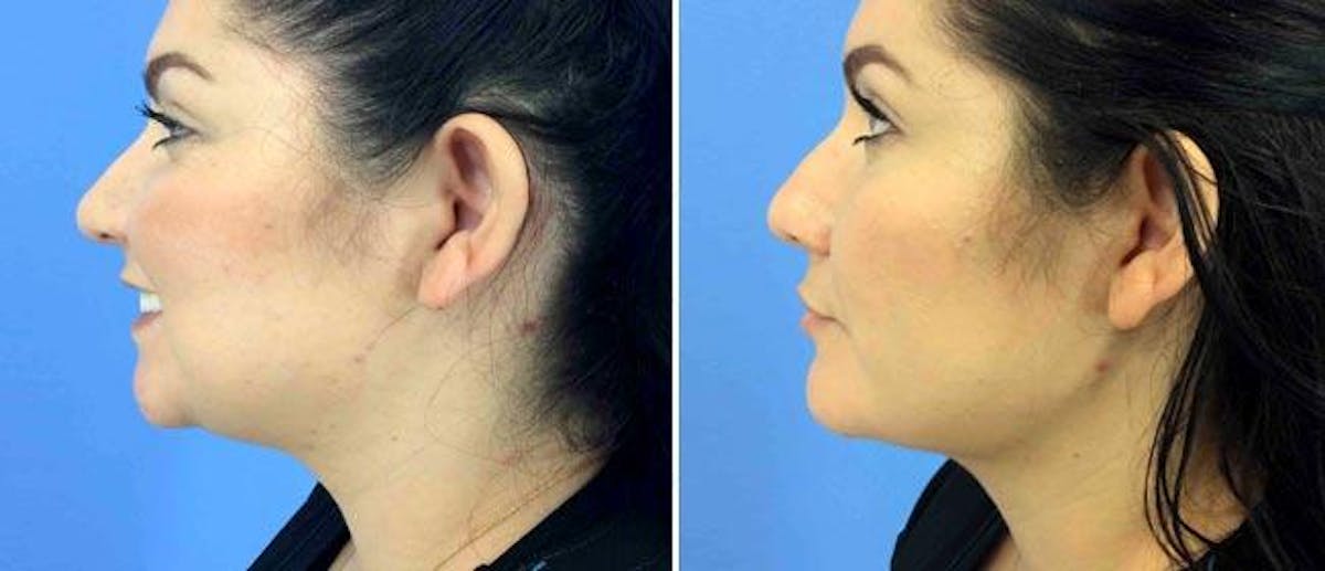 Facial Liposuction Before & After Gallery - Patient 38566666 - Image 1