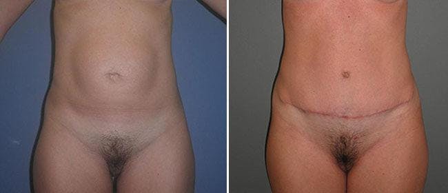 Abdominoplasty (Tummy Tuck) Before & After Gallery - Patient 38566670 - Image 1