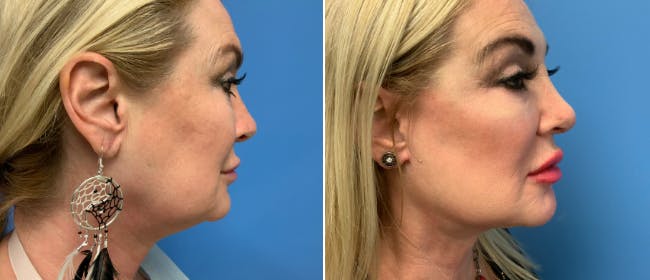 Facelift Before & After Gallery - Patient 38566667 - Image 2