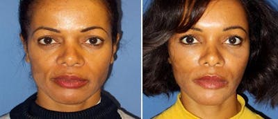 Fat Injections Before & After Gallery - Patient 38566674 - Image 1