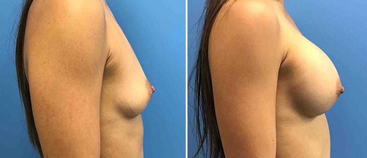 Breast Augmentation Before & After Gallery - Patient 38566675 - Image 1
