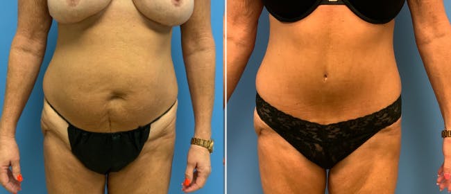 Liposuction Before & After Gallery - Patient 38566663 - Image 3