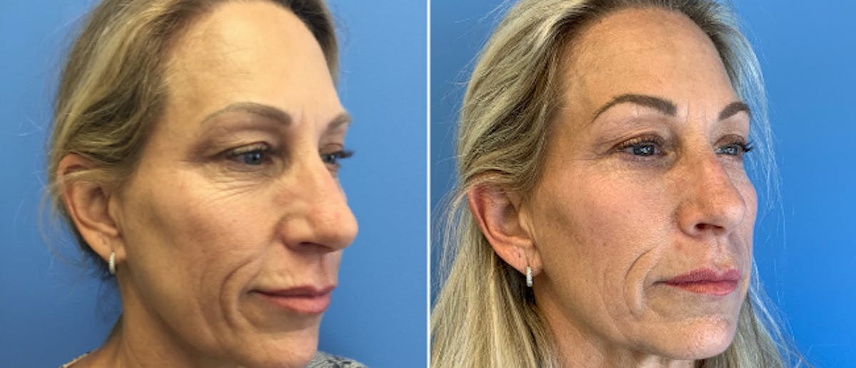 Eyelid Surgery Before & After Gallery - Patient 38566671 - Image 2