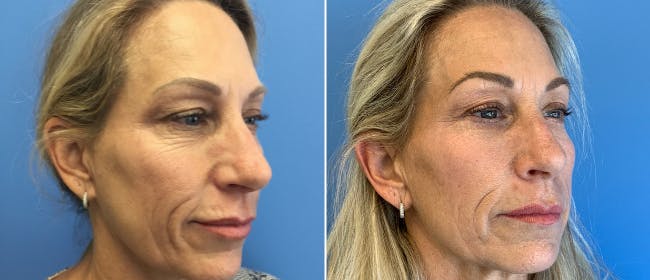 Eyelid Surgery Before & After Gallery - Patient 38566671 - Image 2