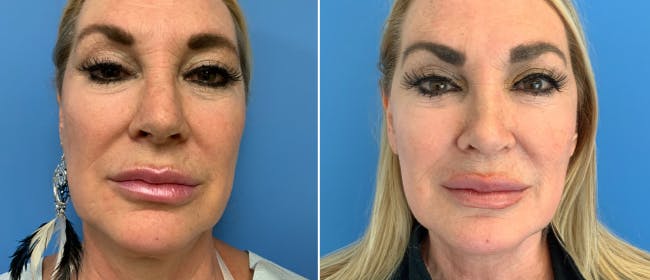 Facelift Before & After Gallery - Patient 38566667 - Image 3