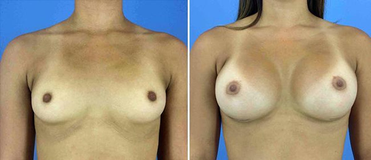 Breast Augmentation Before & After Gallery - Patient 38566681 - Image 1