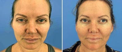 Fat Injections Before & After Gallery - Patient 38566679 - Image 1