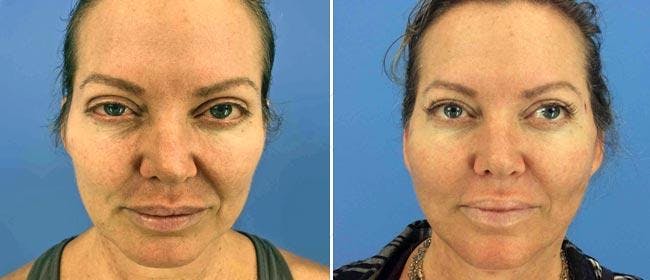 Fat Injections Before & After Gallery - Patient 38566679 - Image 1