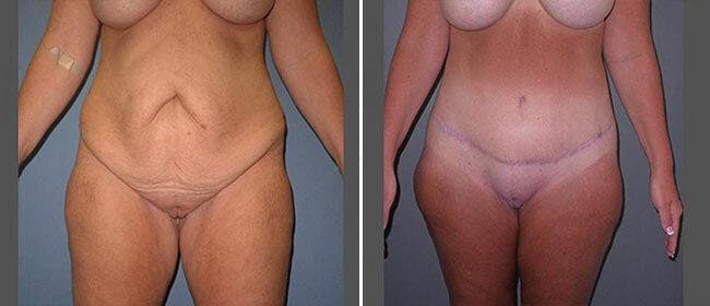Abdominoplasty (Tummy Tuck) Before & After Gallery - Patient 38566682 - Image 1