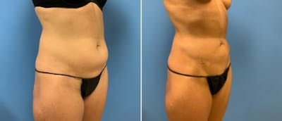 Liposuction / Bodytite Before & After Gallery - Patient 38566683 - Image 1