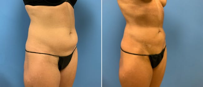 Liposuction Before & After Gallery - Patient 38566683 - Image 1