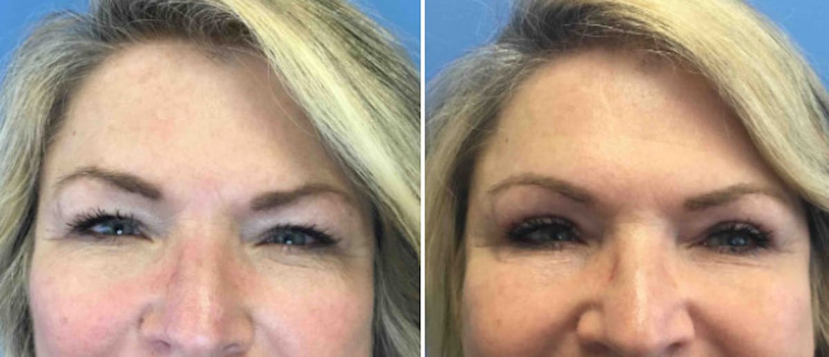 Eyelid Surgery Before & After Gallery - Patient 38566685 - Image 1