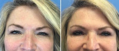 Eyelid Surgery Before & After Gallery - Patient 38566685 - Image 1
