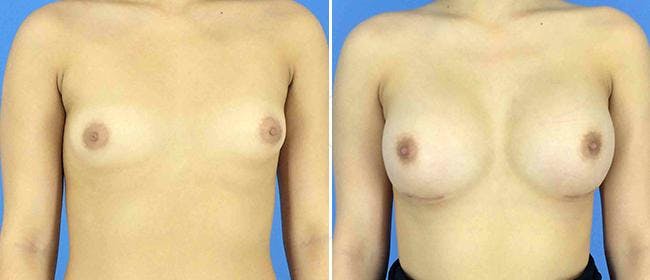 Breast Augmentation Before & After Gallery - Patient 38566688 - Image 1