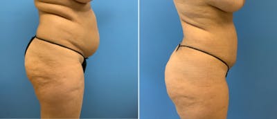 Liposuction / Bodytite Before & After Gallery - Patient 38566692 - Image 1