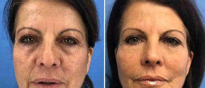 Eyelid Surgery Before & After Gallery - Patient 38566691 - Image 1